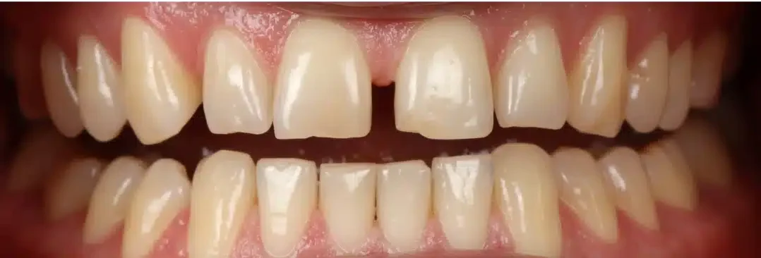 Invisalign smile before transformation treating gaps in Sarasota, FL