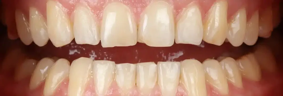 Invisalign smile transformation treating gaps in Sarasota, FL