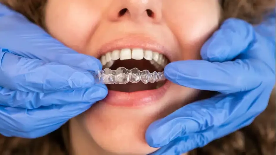a close up of patient's mouth while dentist places an Invisalign tray on the upper teeth