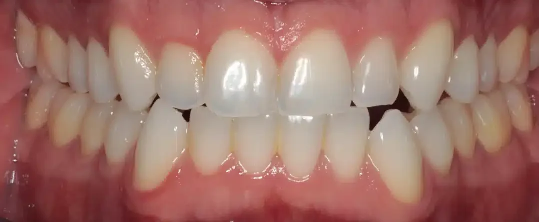 Patient smile before Invisalign Treatment in Sarasota, FL
