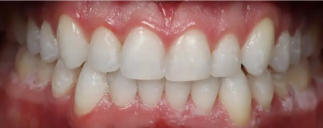 Patient straightened smile after Invisalign Treatment in Sarasota, FL