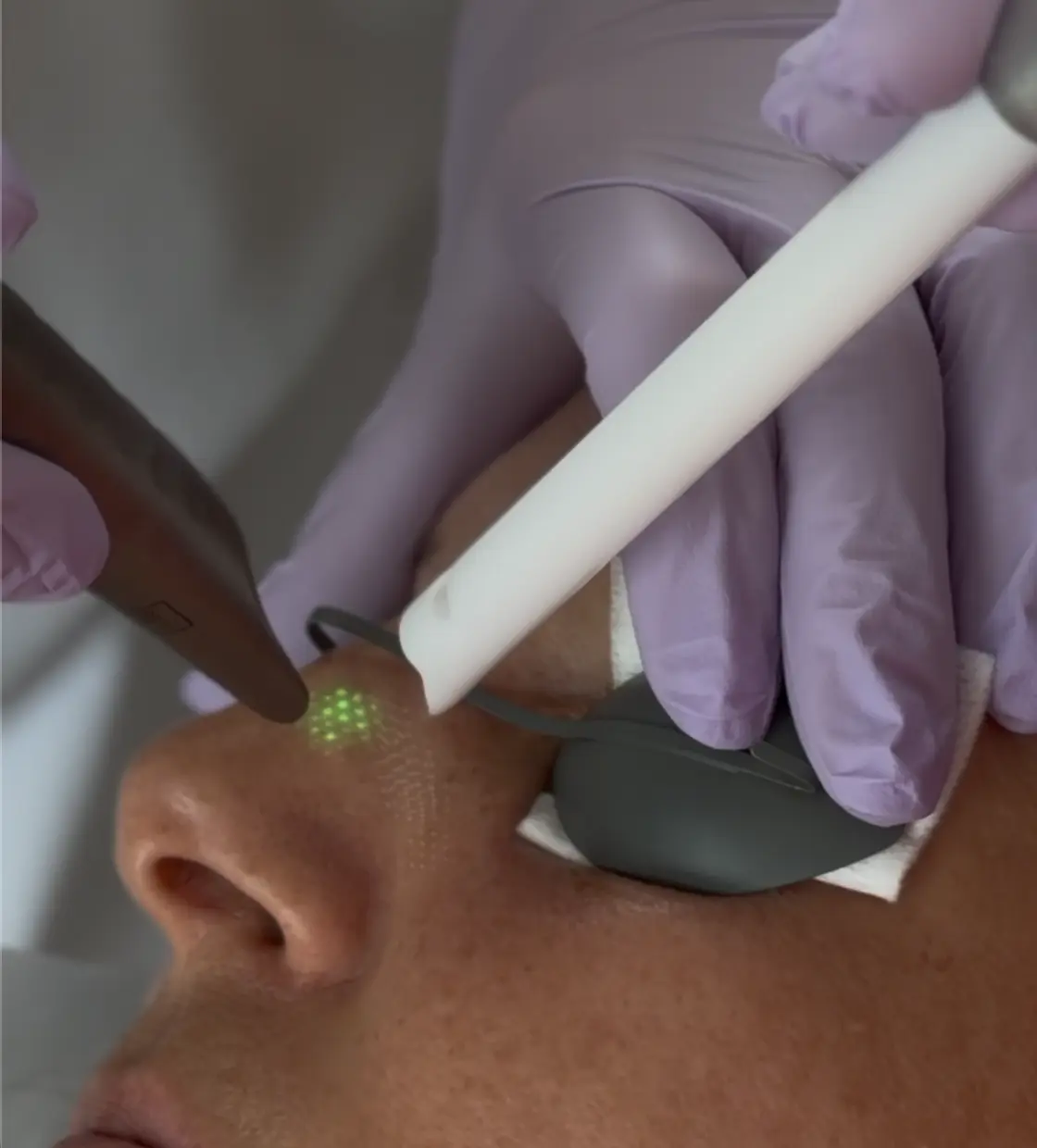 Fotona laser treatment being performed at Modern Smile Design in Sarasota