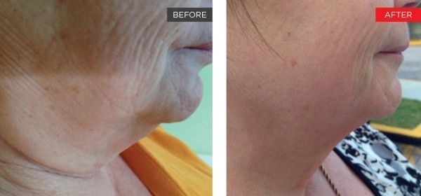Before and after Fotona SmoothLiftin showing tighter, smoother skin along the jawline and neck