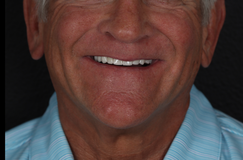 Senior man smiling after implants installation at Modern Smile Design in Sarasota, FL