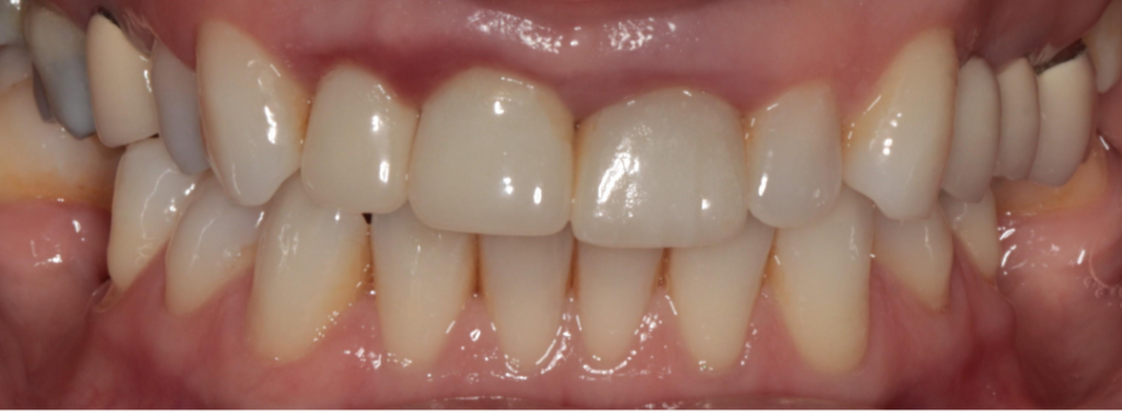 dental veneers before