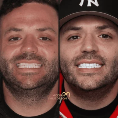 patient before and after veneers in sarasota, fl