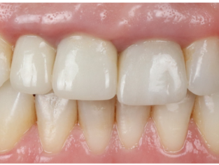 dental veneers after, Sarasota, FL