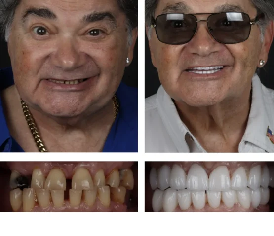 smiling patient before and after Veneers at modern smile design in sarasota, FL