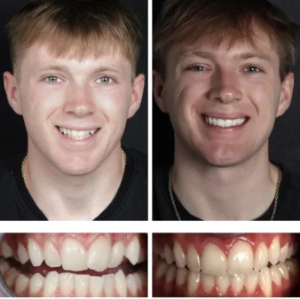smiling patient before and after Invisalign treatment at modern smile design in sarasota, FL