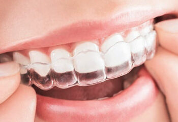 Invisalign at Modern Smile Design in Sarasota. Invisalign at Modern Smile Design in Sarasota.