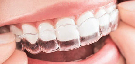 Invisalign at Modern Smile Design in Sarasota.