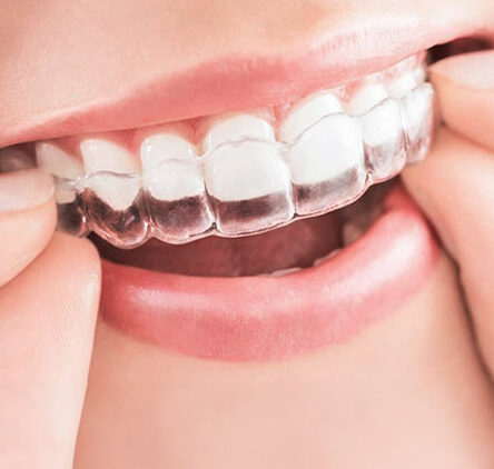 Invisalign at Modern Smile Design in Sarasota.