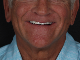 Senior man smiling after implants installation at Modern Smile Design in Sarasota, FL