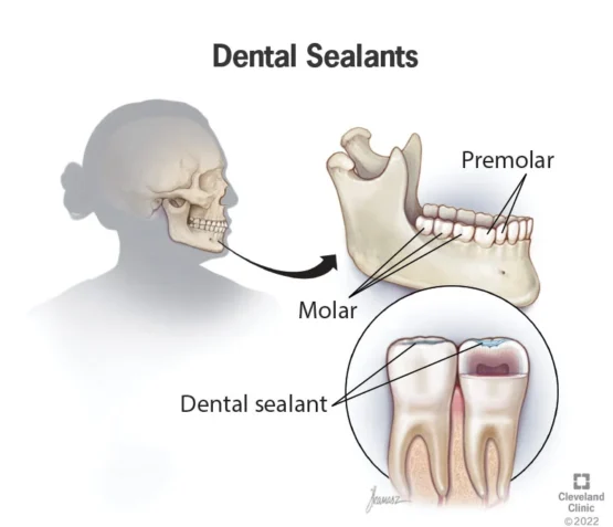 Diagram showing dental sealant placement on molars