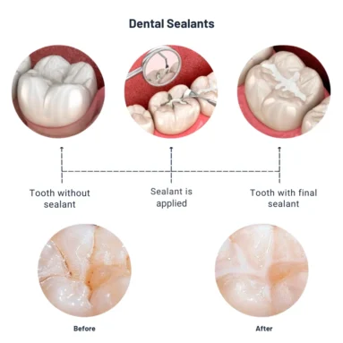 Step-by-step illustration of dental sealant application process