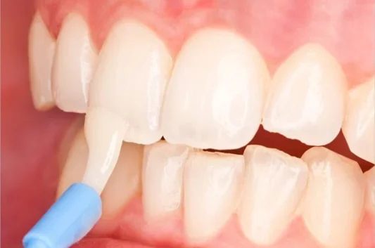 Close-up of professional fluoride treatment being applied to teeth