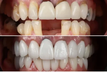 full-mouth-reconstruction before and after of a full mouth reconstruction case