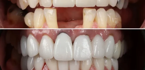before and after of a full mouth reconstruction case
