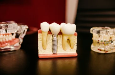 implantsphoto
