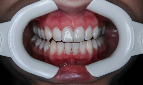 Intraoral view of mouth during oral cancer screening